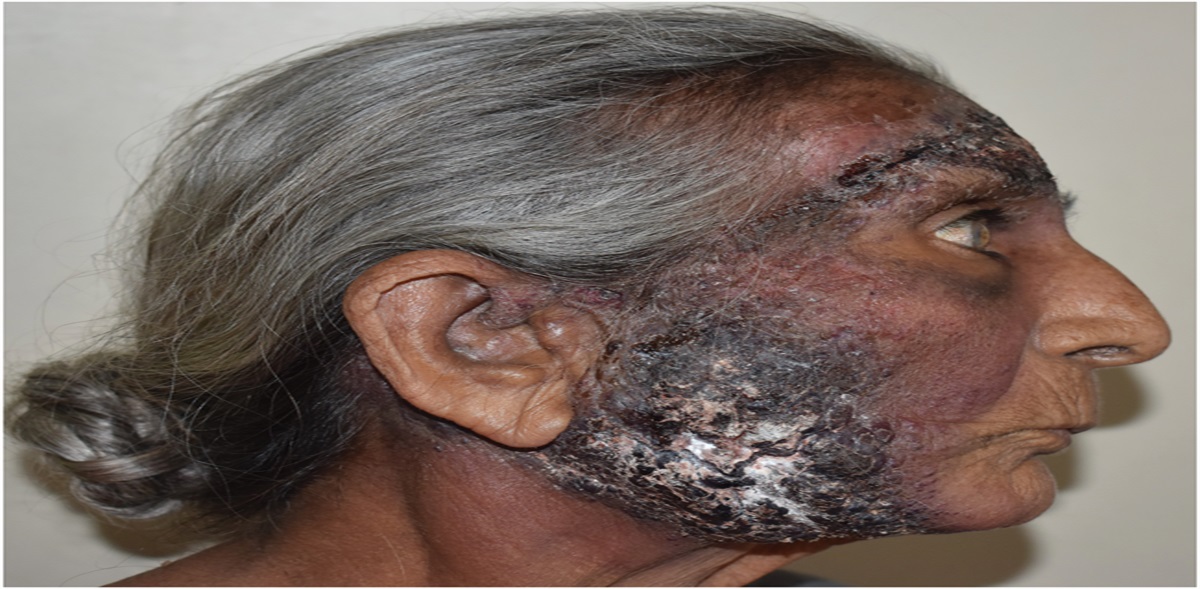 Hemorrhagic Blisters With Crusting Over Face in an Elderly Woman