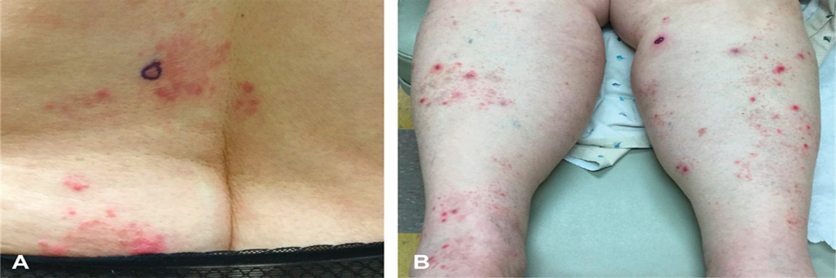Sarcoidal Granuloma Annulare–Like Dermatitis and Vasculitis With Granulomatous Features: An Atypical Case of Giant Cell Arteritis