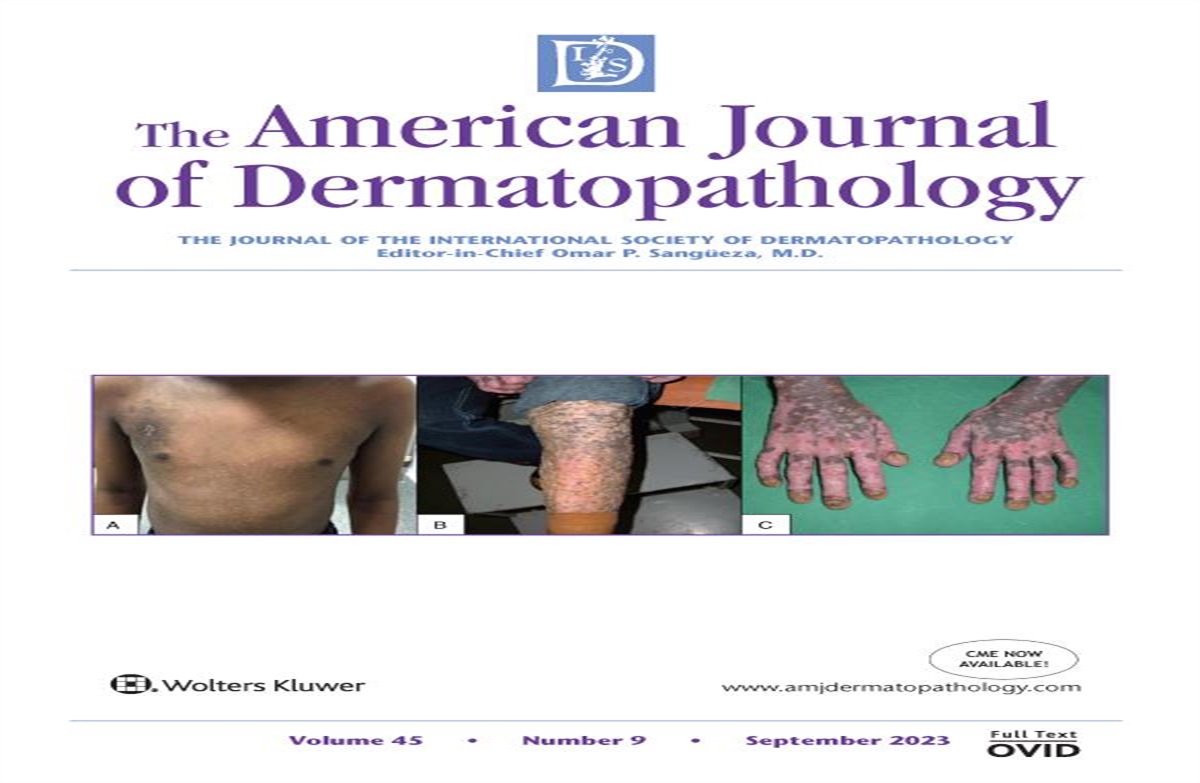 Eruptive Pruritic Maculopapular Rash After Pfizer-BioNTech COVID-19 Vaccination: Challenge