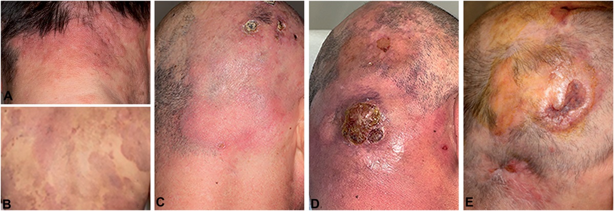 Anaplastic Large Cell Transformation of Mycosis Fungoides: Case Report and Review of the Literature