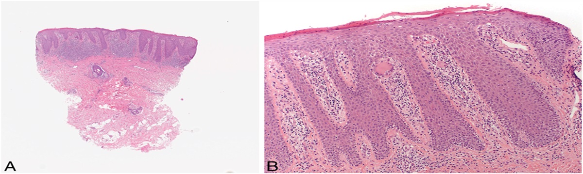 Idiopathic Lichenoid and Granulomatous Vulvitis: A Distinct Clinicopathological Entity