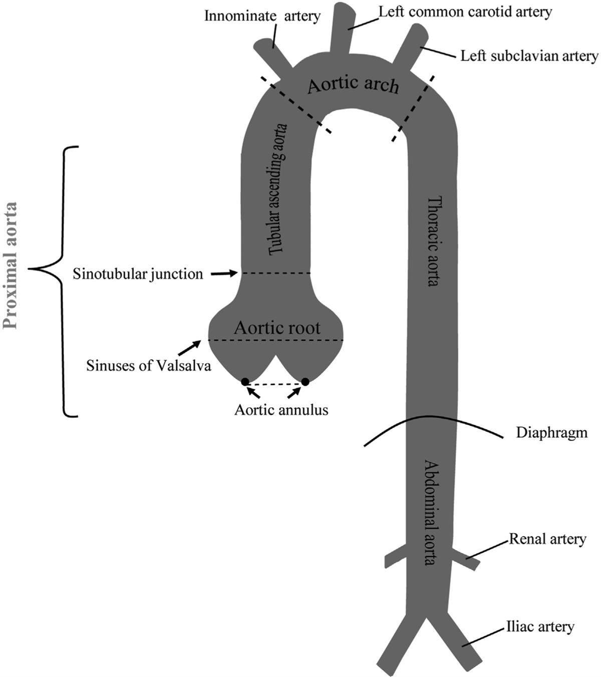 Proximal aorta dilatation in hypertension