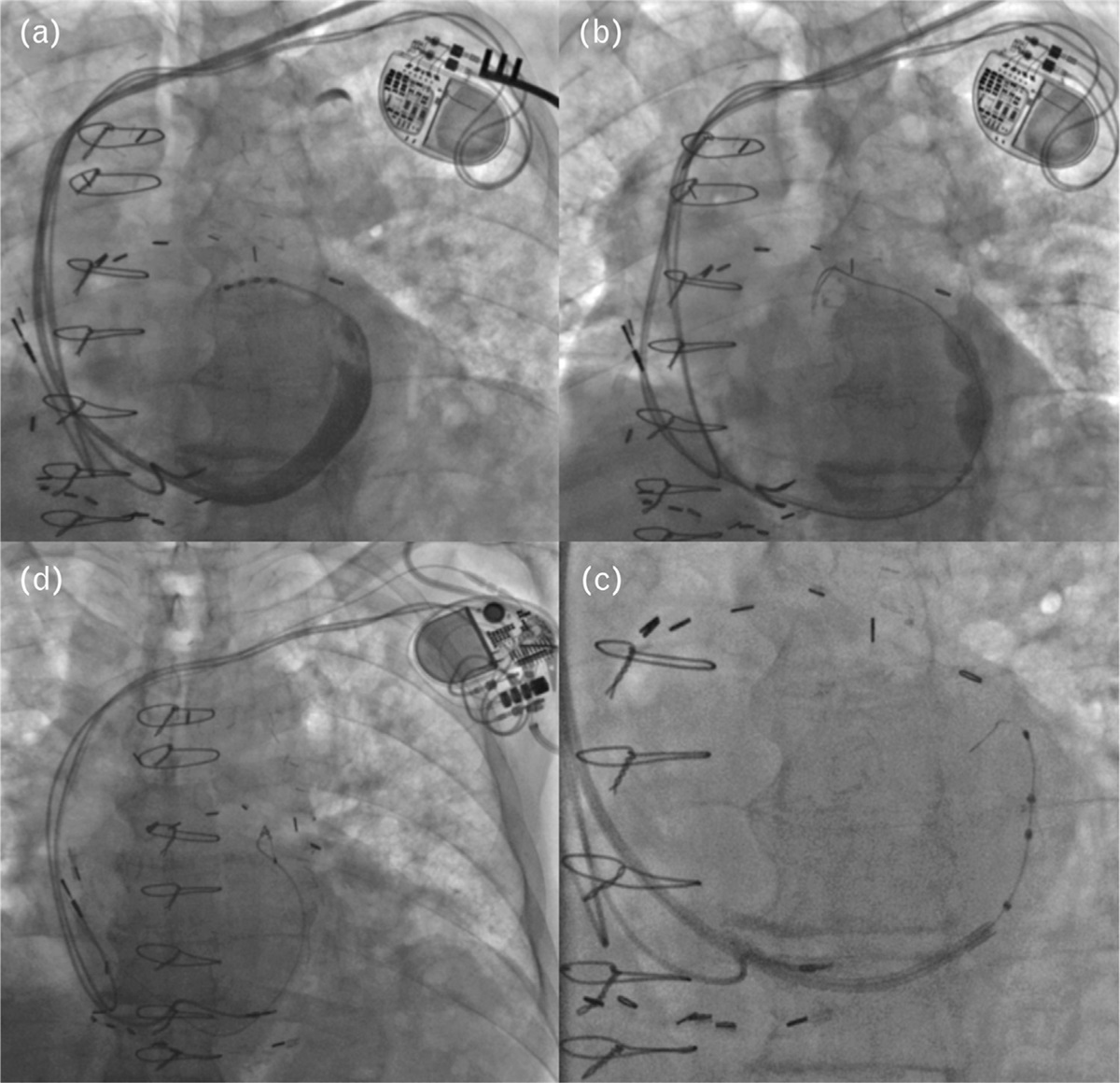 First-in-man parallel implantation of a coronary sinus Reducer and biventricular pacemaker