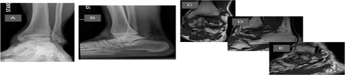 A Novel Technique for Lateral Ankle Ligament Reconstruction in a Total Ankle Total Talus Replacement Case