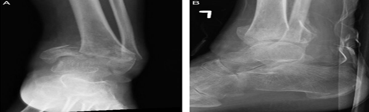 Arthroscopic Tibio-talar Calcaneal Nailing for Complex Distal Third and Intra-Articular Tibia Fractures