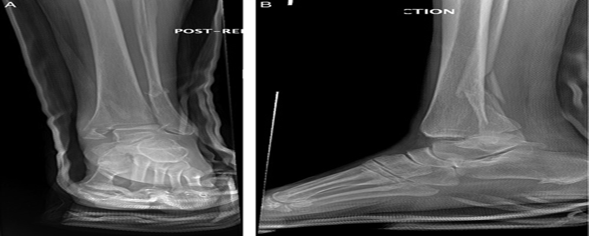 Technique Tip: Using a Targeting Guide to Place Flexible Syndesmosis Fixation, in Ankle Fractures With a Dual Plate Construct