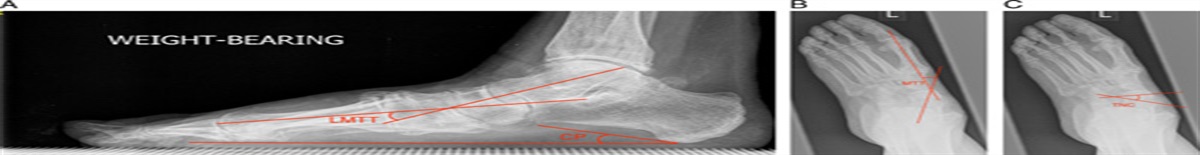 A Modified Technique for Lateral Column Lengthening as Part of Adult Acquired Flatfoot Deformity Correction: An Intact Medial Calcaneal Cortex, a Low-Profile Locking Plate With a Combination of Autologous Calcaneal Bone Graft and Demineralized Human Bone Matrix