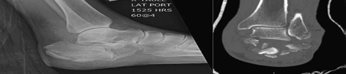 Technique Tip: Maintaining Anatomy While Achieving Compression During Primary Subtalar Fusion in Setting of Comminuted Calcaneal Tuberosity Fracture