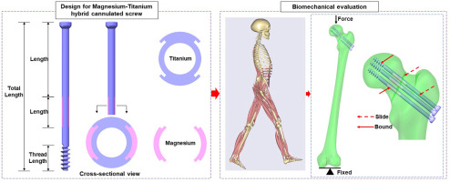 The novel magnesium–titanium hybrid cannulated screws for the treatment of vertical femoral neck fractures: Biomechanical evaluation