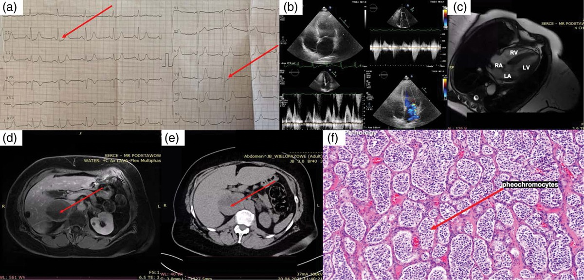 Takotsubo syndrome with several hypertensive crises: an unexpected diagnosis