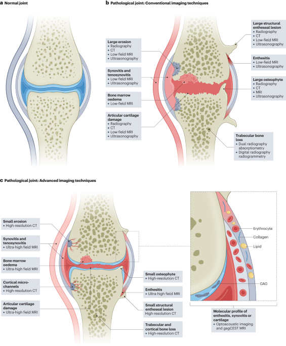 Imaging in inflammatory arthritis: progress towards precision medicine
