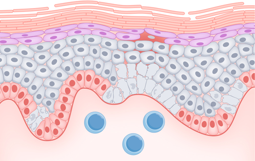 HIF-1 inhibition mitigates skin damage in CLE