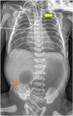 Minimally invasive management of combined esophageal atresia with tracheoesophageal fistula and duodenal atresia: a comprehensive case report