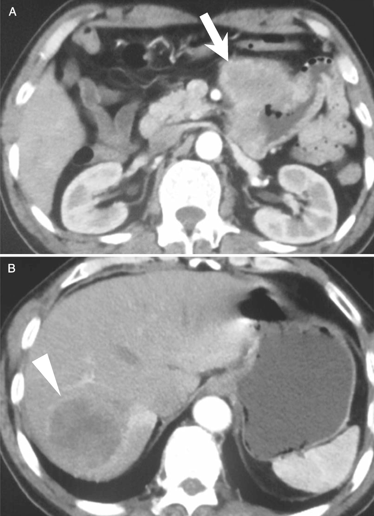FDG PET/CT in Follicular Dendritic Cell Sarcoma of the Jejunum With Hepatic Metastasis