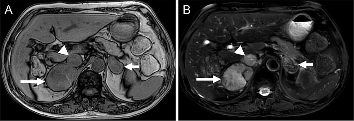 Right Adrenocortical Carcinoma Coexisting With Left Adrenal Sarcomatoid Carcinoma on FDG PET/CT