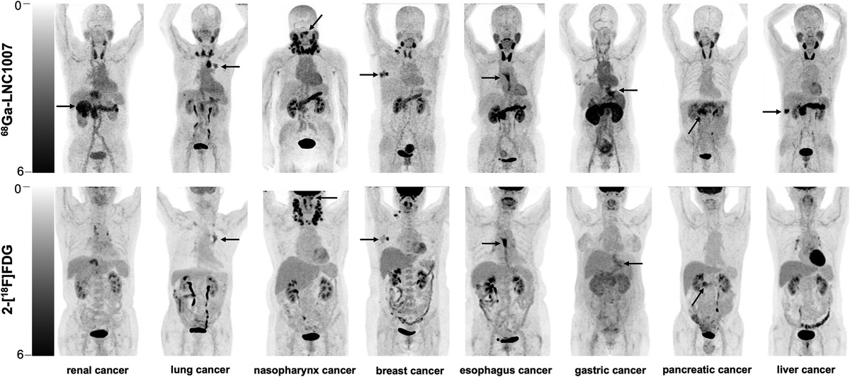 A Head-to-Head Comparison of 68Ga-LNC1007 and 2-18F-FDG/68Ga-FAPI-02 PET/CT in Patients With Various Cancers