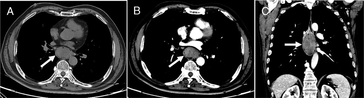 A Case of Primary Esophageal Sarcomatoid Carcinoma Detected by 18F-FDG PET/CT