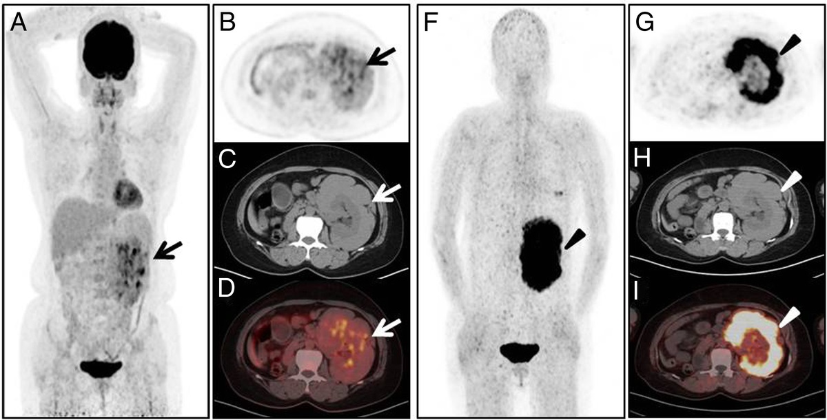 Comparison of 18F-FDG and 68Ga-FAPI PET/CT in a Rare Renal Leiomyoma