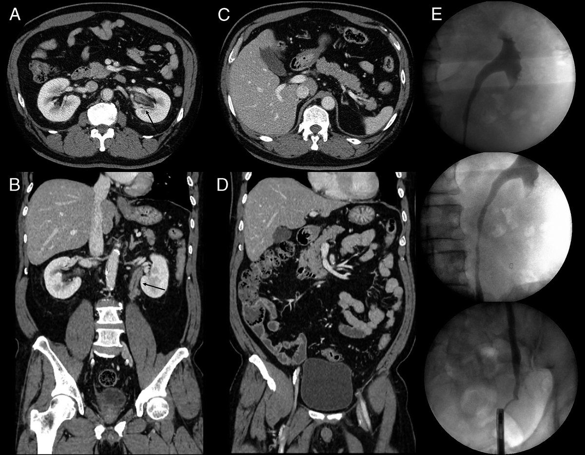 Serial 68Ga-FAPI PET/CT After Treatment of Immunoglobulin G4-Related Pancreatitis and Retroperitoneal Fibrosis