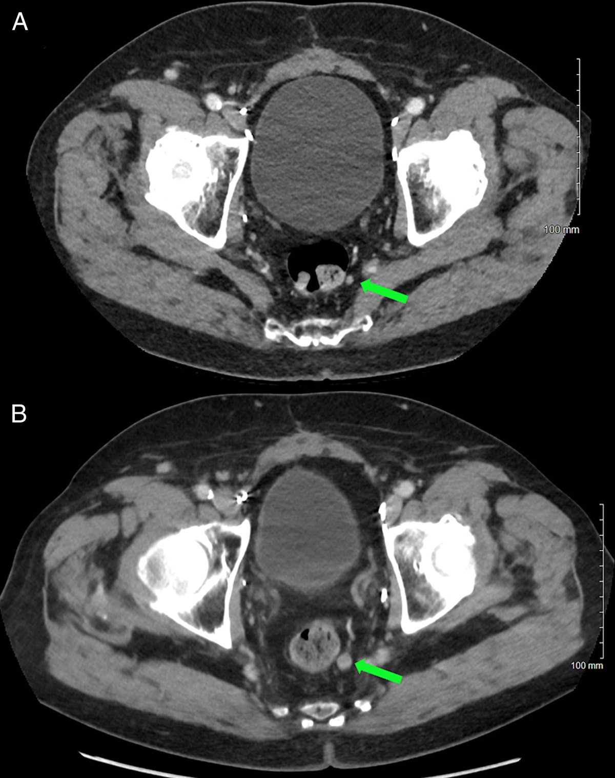 Prostate Adenocarcinoma Metastasis to the Rectal Submucosa and Mesorectal Lymph Node on 18F-PSMA PET/CT