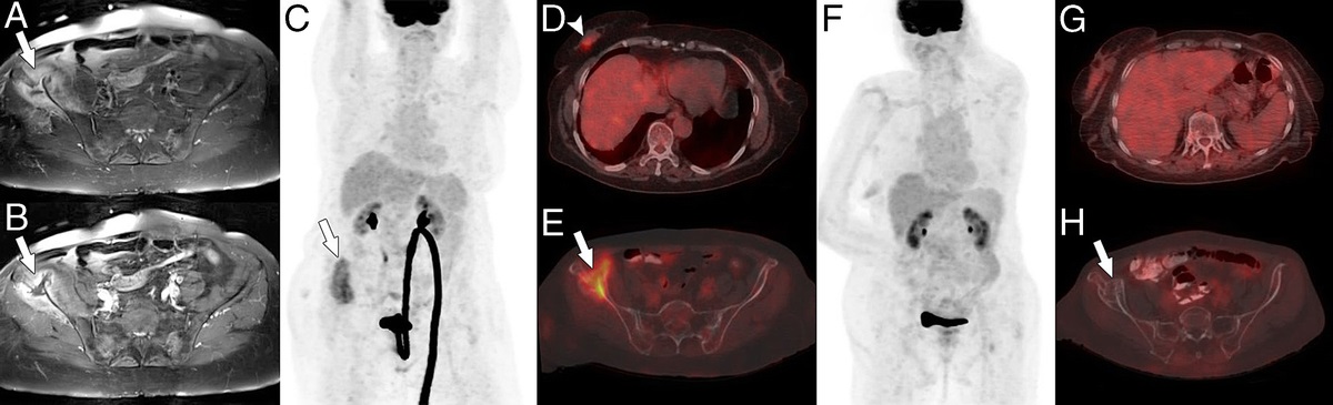 Bone Lipogranuloma Mimicking Metastatic Disease on 18F-FDG PET/CT