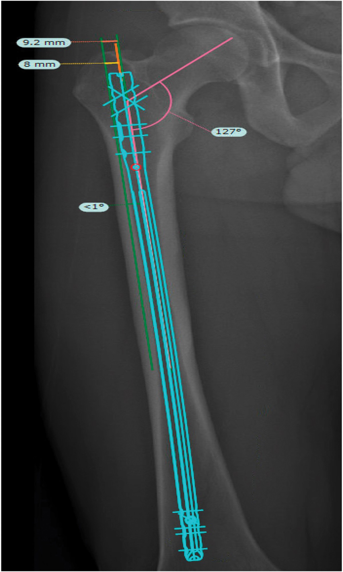 Optimizing the Entry Point for Reconstruction Nailing of the Femur