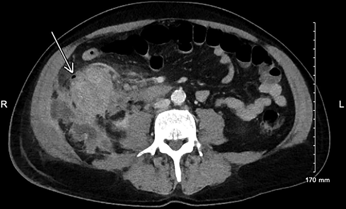 Microsatellite Instability in Colorectal Cancer: The Evolving Role of Immunotherapy