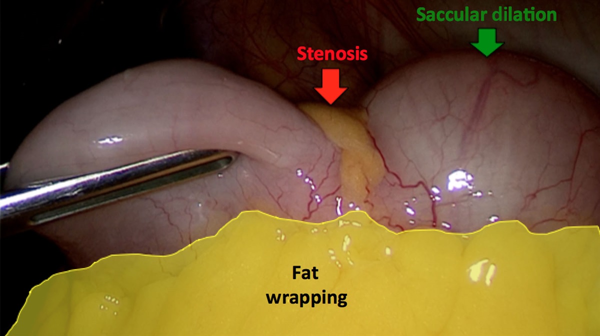 Laparoscopic Enterectomy With Intracorporeal Anastomosis for Stricturing Crohn’s Disease of the Small Bowel