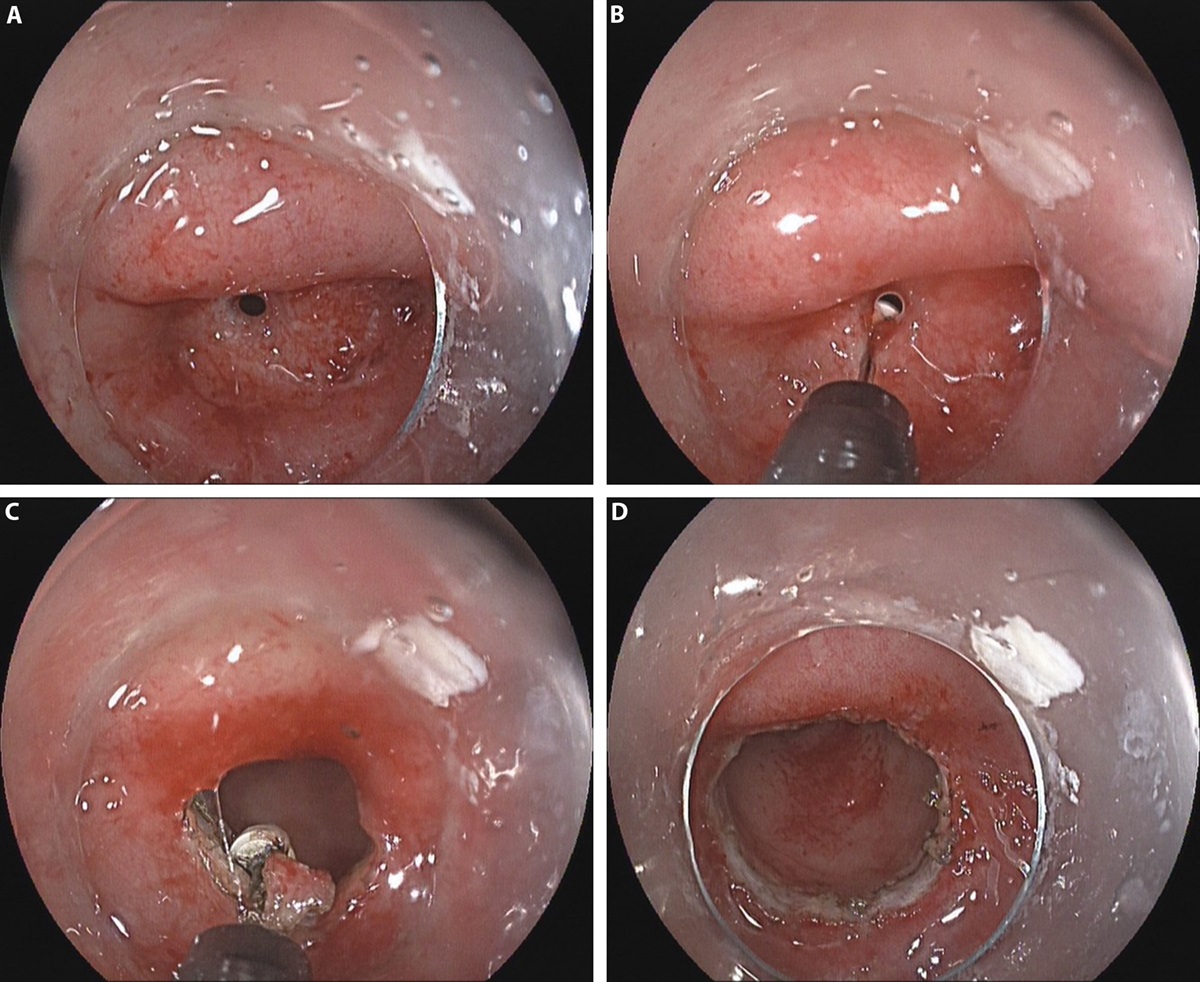 Comparison of the Efficacy of Endoscopic Radial Incision and Cutting Procedure and Endoscopic Balloon Dilation for Benign Anastomotic Stricture After Low Anterior Resection Combined With Preventive Loop Ileostomy in Rectal Cancer