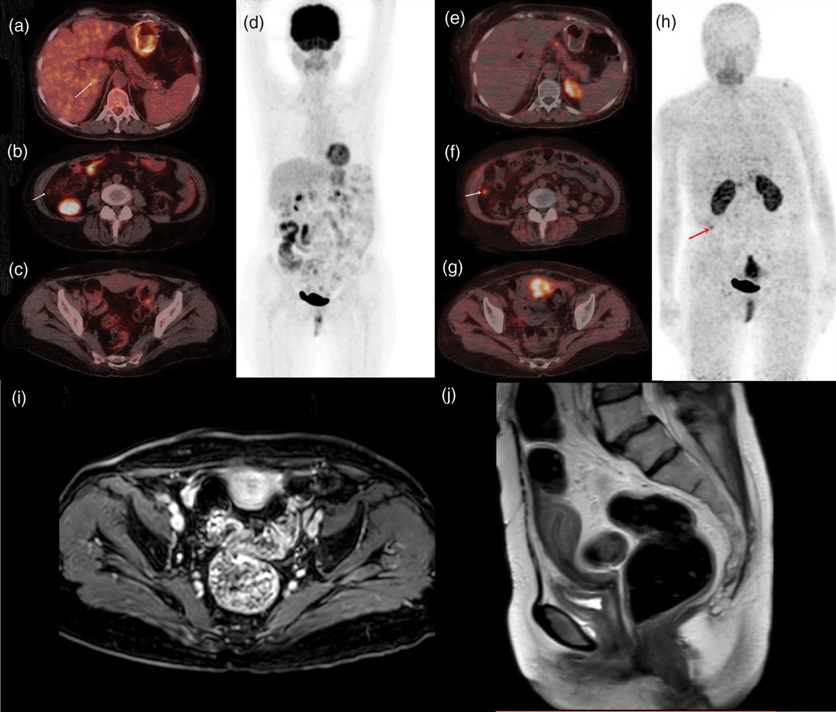 Challenging false positive findings in 68Ga-FAPI PET: insights from a clinical case