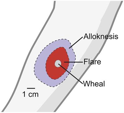 A tactile twist: decoding the phenomena of mechanical itch and alloknesis