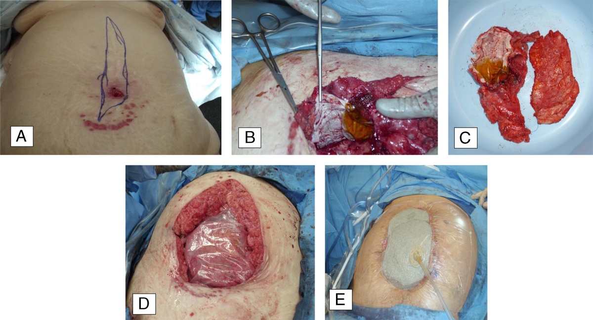Outcomes of Immediate Multistaged Abdominal Wall Reconstruction of Infected Mesh: Predictors of Surgical Site Complications and Hernia Recurrence