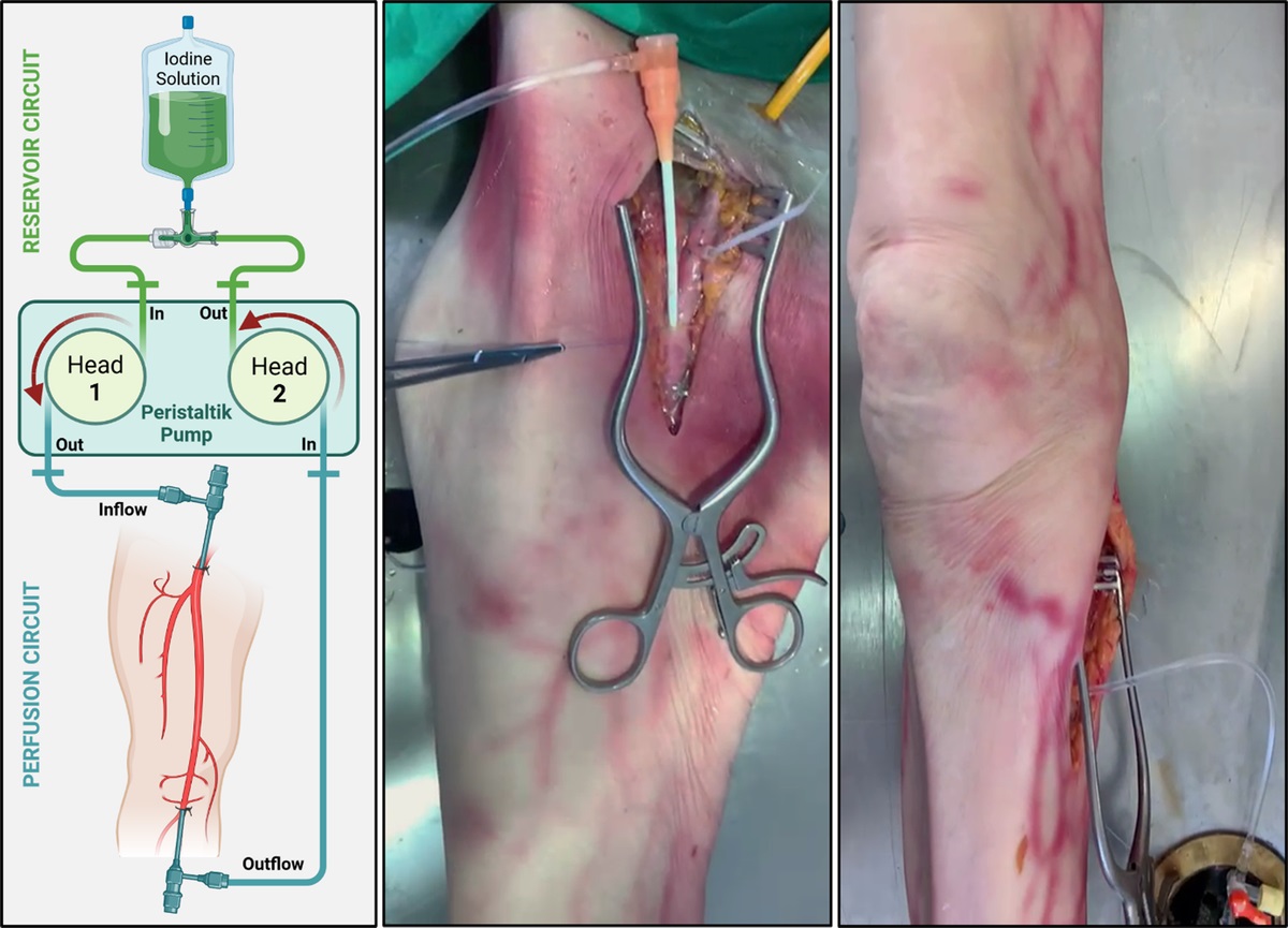 Photon-Counting Versus Energy-Integrating Detector CT Angiography of the Lower Extremity in a Human Cadaveric Model With Continuous Extracorporeal Perfusion