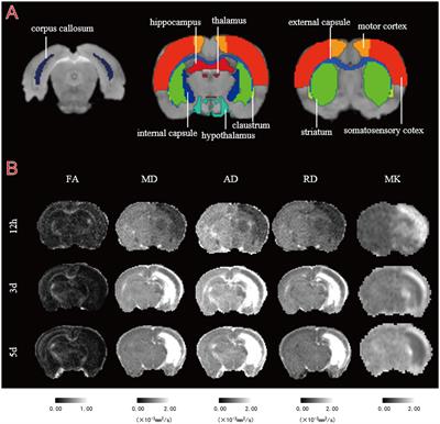 MR imaging and outcome in neonatal HIBD models are correlated with sex: the value of diffusion tensor MR imaging and diffusion kurtosis MR imaging