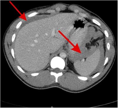 Spontaneous rupture of a splenic artery aneurysm causing acute abdomen in a 19-year-old male patient: a case report