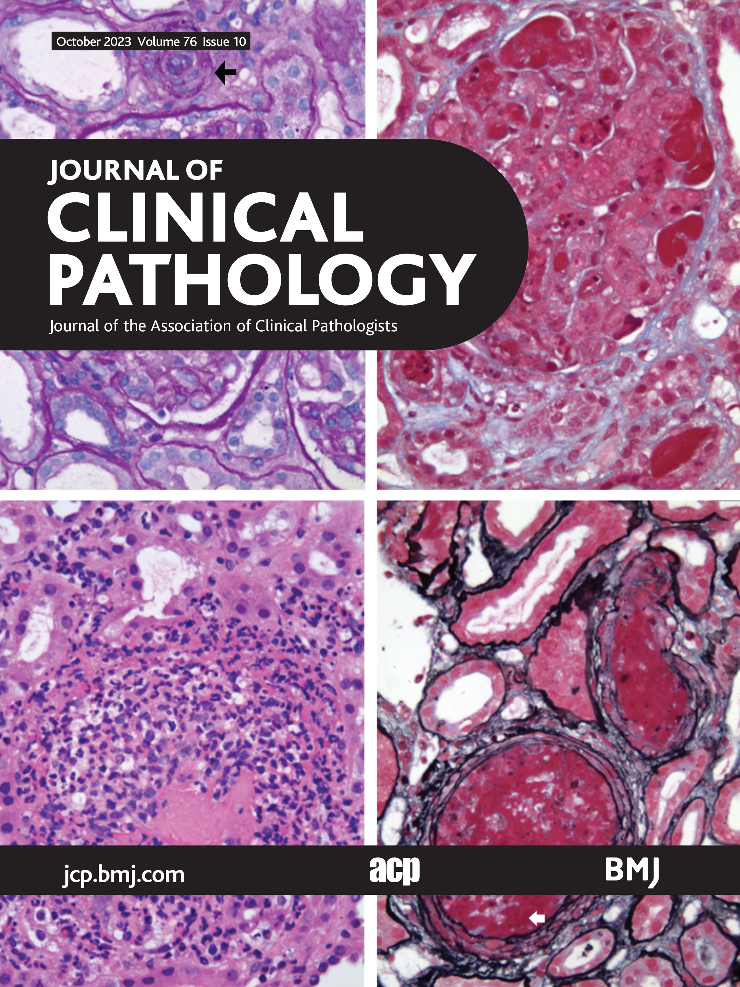 Predicting the likelihood of a BRCA1/2 pathogenic variant being somatic by testing only tumour DNA in non-mucinous high-grade epithelial ovarian cancer