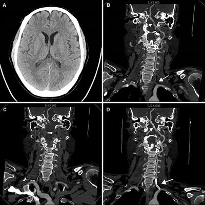 Case report: Retrograde endovascular recanalization of vertebral artery occlusion with non-tapered stump via the deep cervical collateral