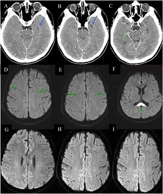 Case Report: High-dose steroid and IVIG successful treatment in a case of COVID-19-associated autoimmune encephalitis: a literature review