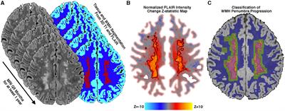 Diffusion tensor free water MRI predicts progression of FLAIR white matter hyperintensities after ischemic stroke