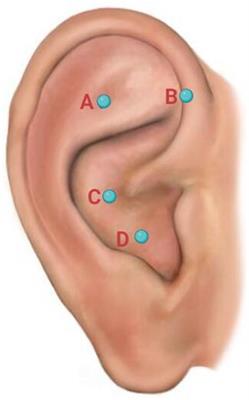 Auricular acupuncture for persistent insomnia and anxiety associated with COVID-19: a case report