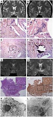 Sellar xanthogranuloma as a diagnostic challenge: a report on five cases