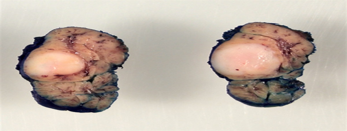 Palisading Adenocarcinoma: A Morphologically Unique Salivary Gland Tumor With a Neuroendocrine-like Appearance and a Predilection for the Sublingual Glands of Women