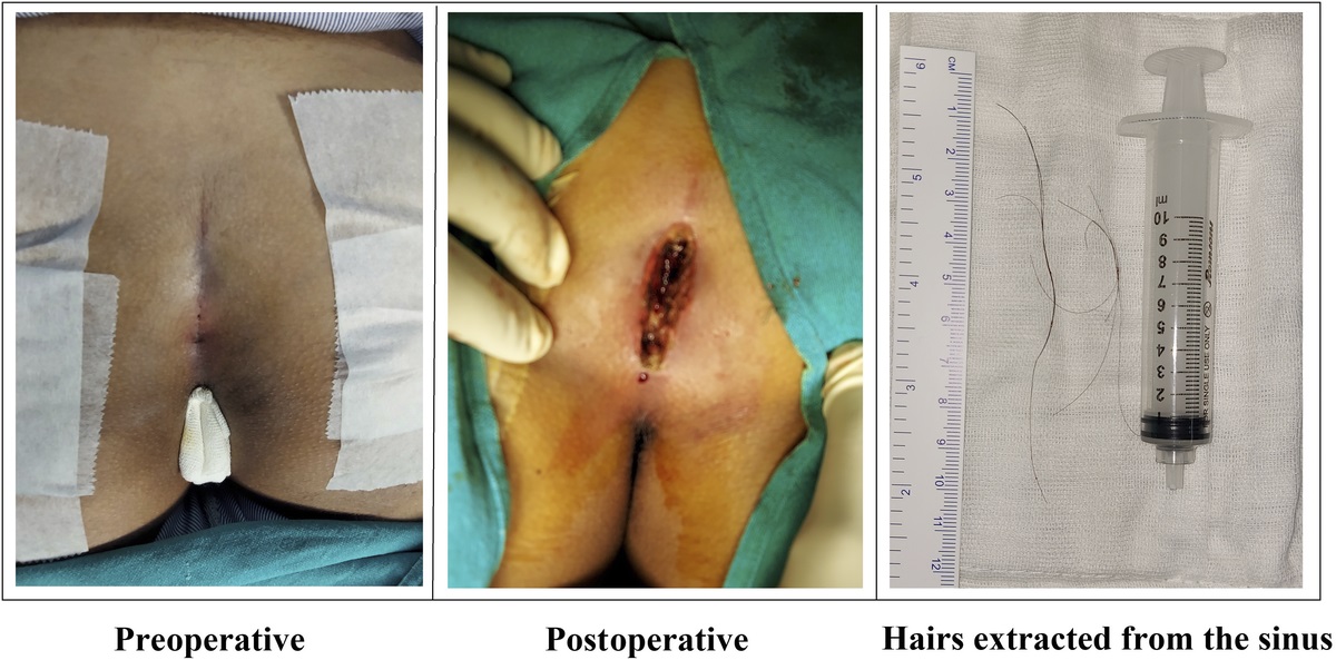 Terminal Hairs That Resemble Occipital Hairs in Pilonidal Sinus Disease: A Case Report