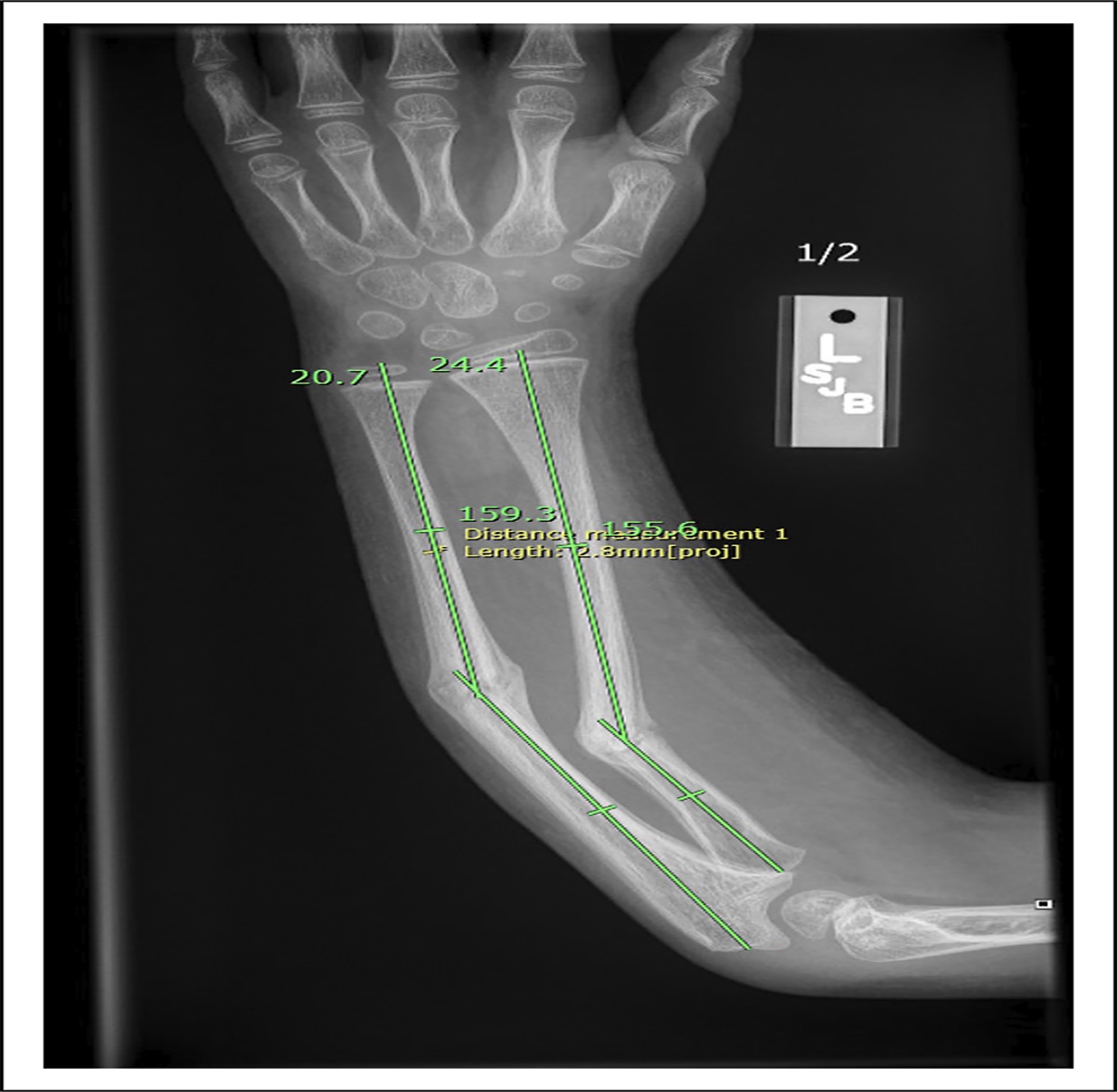 Flexible Titanium Intramedullary Nail Displacement After Magnetic Resonance Imaging
