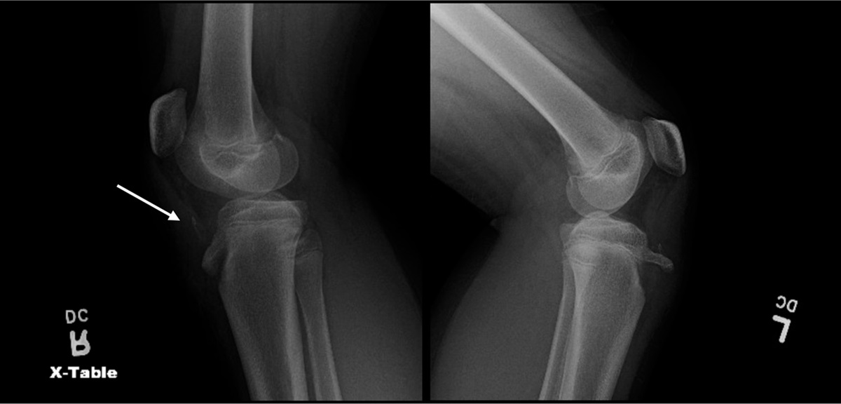 Bilateral Tibial Tubercle Avulsion Fractures With an Associated Patellar Tendon Avulsion in an Adolescent Patient