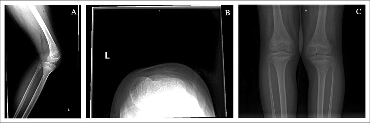 Dislocated Extensor Mechanism in a Child With Bilateral Absent Patella Without Other Congenital Abnormalities