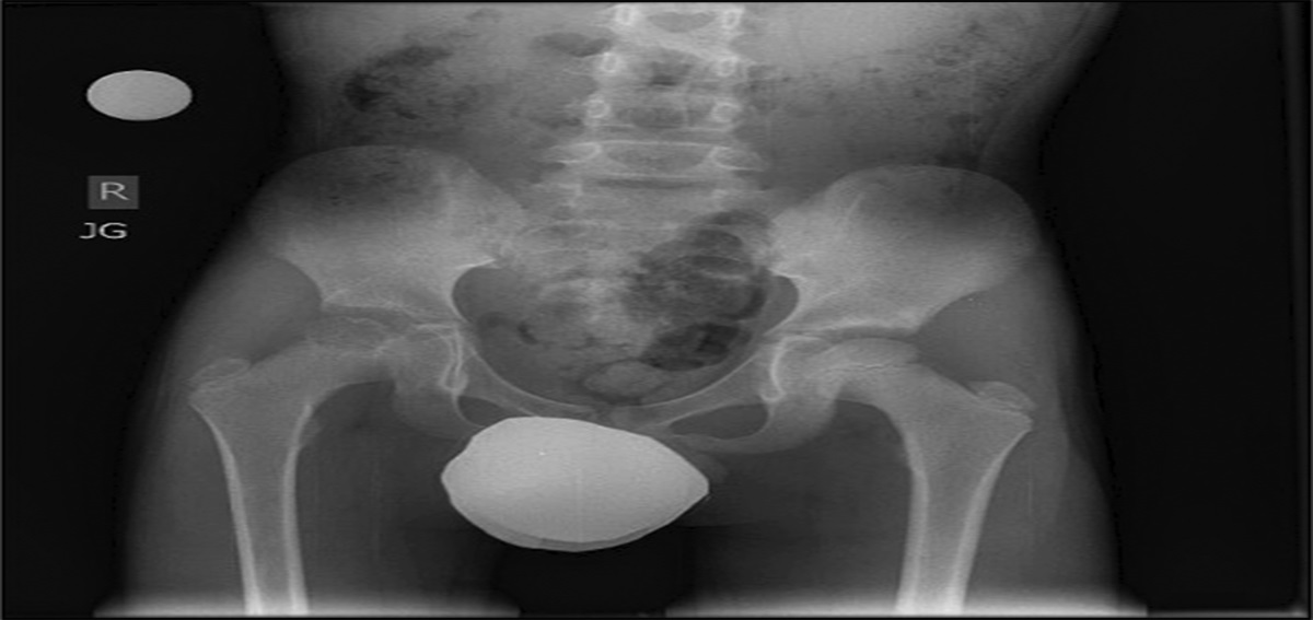 Use of a Cannulated, Percutaneous Expandable Reamer for Physeal Sparing Excision of a Femoral Head Chondroblastoma