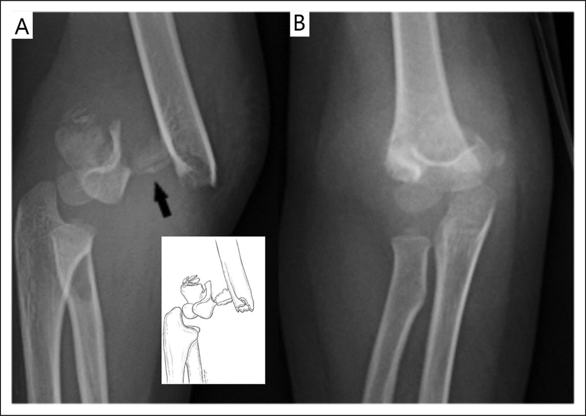 A Type IV Extension Supracondylar Fracture With Comminuted Fracture Pattern: A Case Report