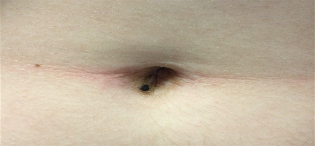 Evaluation of a Yellowish-Tan Plaque Surrounding a Preexisting Nevus