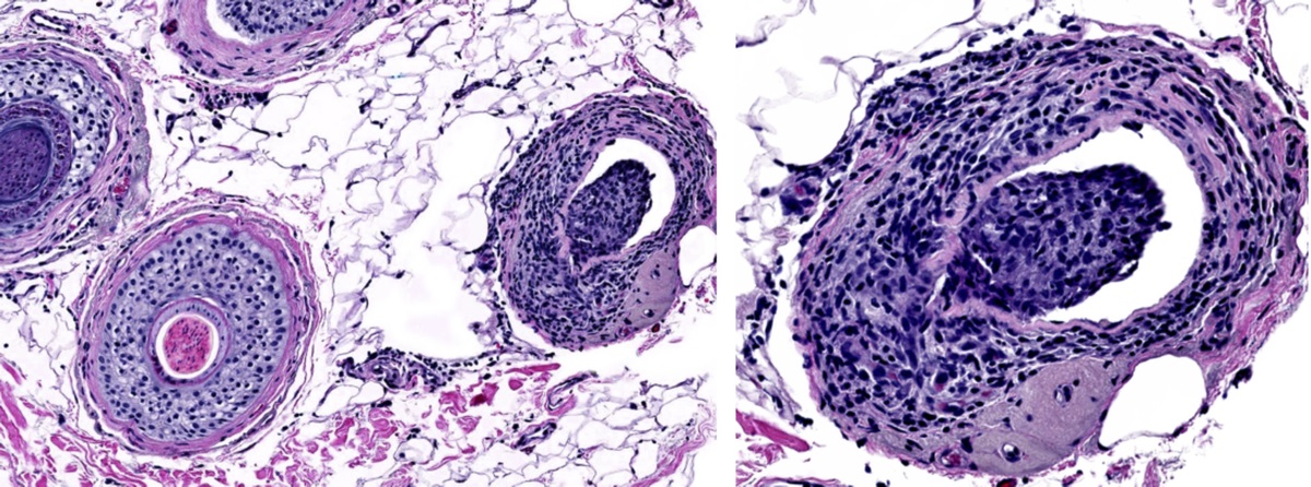 Use of Platelet-Rich Plasma in the Management of Alopecia Areata